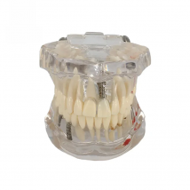 Transparent Disease Teeth Model Dental Implant Teeth Model Dentist Dental Student Learning, Teaching, Research Communication