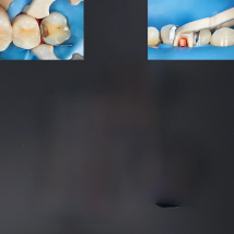 4PCS Dental Resin Clamping Ring Separator Ring Sectional Contoured Metal Matrices Holder Matrix Fixed Clamp Autoclavable