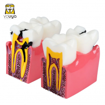 6-faches zahnmedizinisches Modell Molaren pathologisches anatomisches Vergleichsmodell zur Erleichterung der Studie der Zahnstruktur und der Läsionsprozess