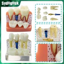 Dental 4-fach Implantat Zähne Modell Analyse Krone Brücke Porzellan Restaurierung Modell Zahnarzt Lehre Studie Demonstration Modell