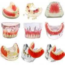 Zähne Implantat Modell Dental 2/4 Implantat Overdenture Restaurierung Obere Untere Zähne Modell Typodont Implantat Verfahren