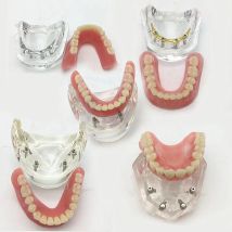 Dental-Implantatmodell mit niedrigem Zahn, abnehmbarer Innenraum, Unterkiefer-Demo, Overdenture für Ober-/Unterricht, Studium, Zahnmedizin-Werkzeuge