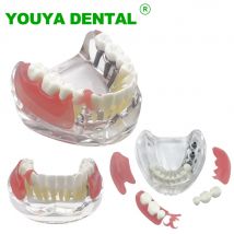 Zahnimplantatmodell mit Wiederherstellung M6006 Overdenture Infererior Demo Unterkieferzahnmodell 3 Implantate Brücke Zahnmedizinprodukt