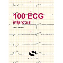 100 Ecg Infarctus