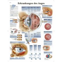Lavagna patologie dell'occhio 3B Scientific – Carta fotografica 200g – 50x67 cm