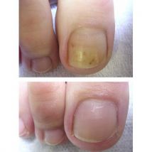 Footlogix Anti-Fungal Toe Tincture Spray 50ml